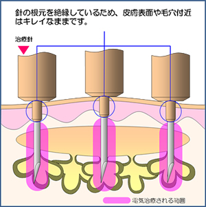 にきび・オイリースキン・毛穴の黒ずみ