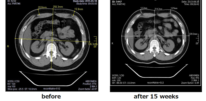 HIFUテクノロジーを搭載した、痩身マシン：リポセル