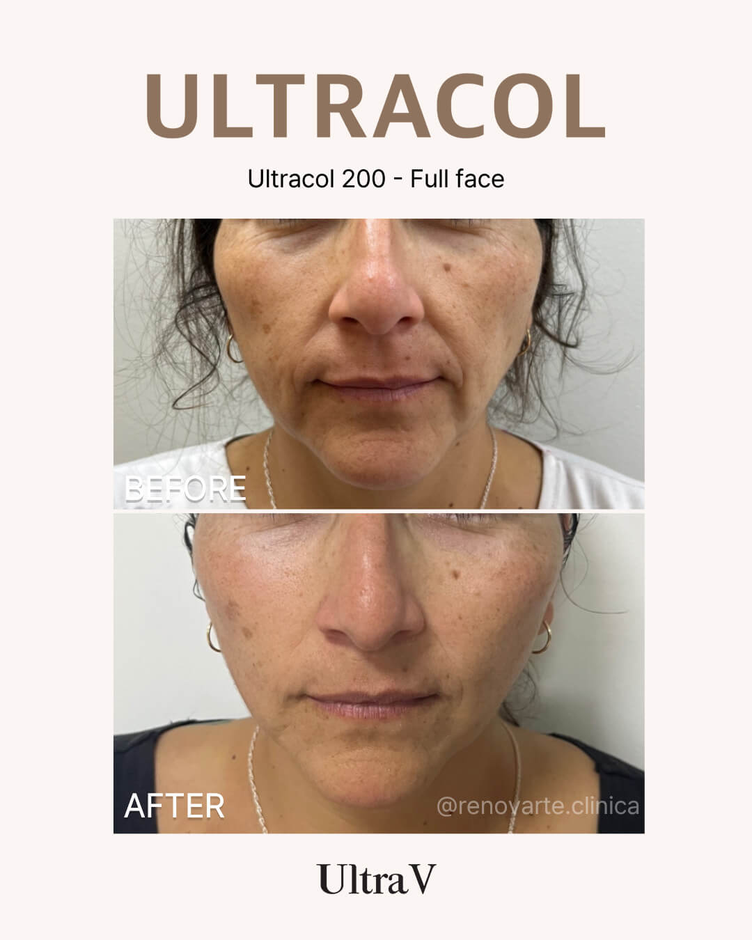 ウルトラコール症例写真1