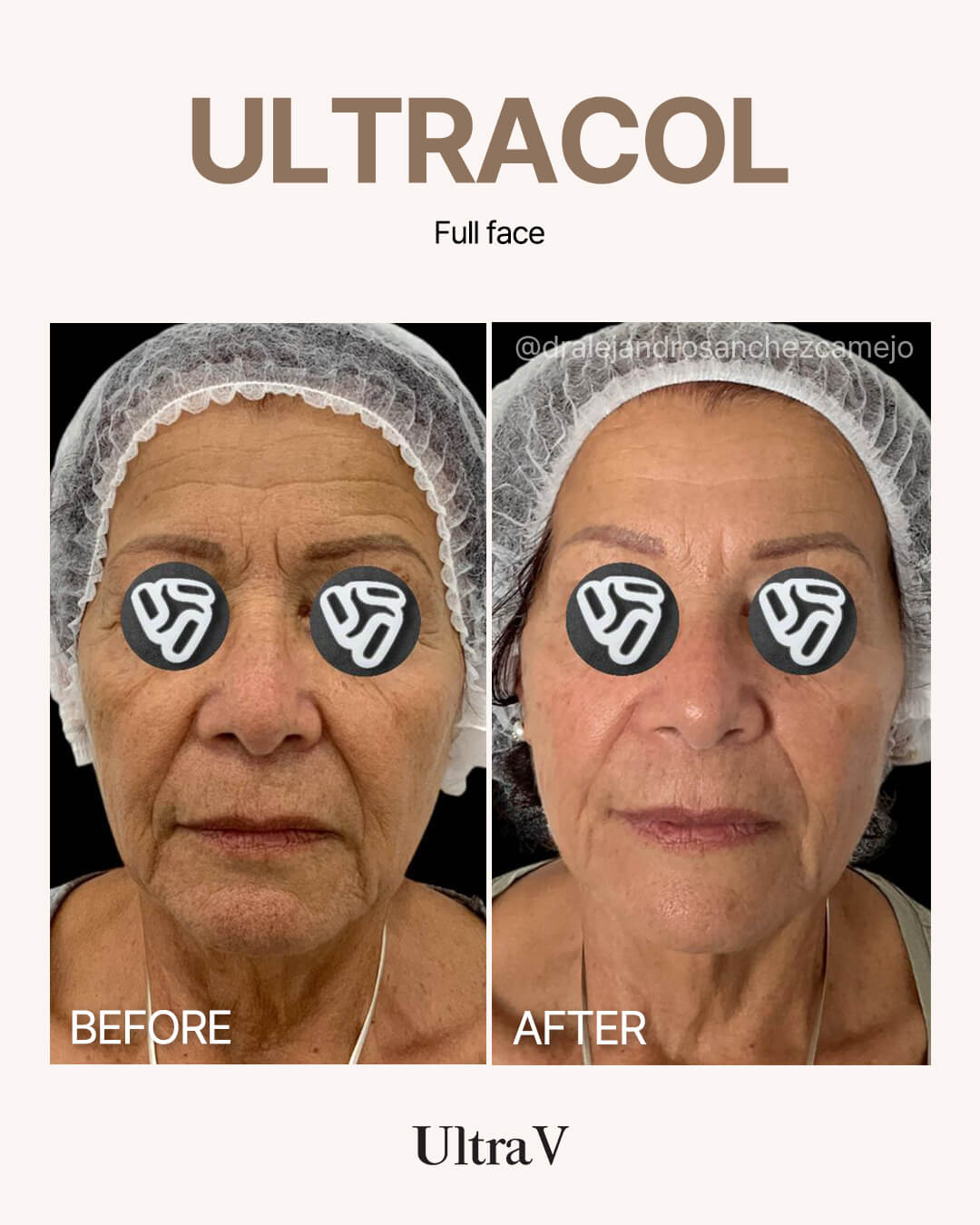 ウルトラコール症例写真2