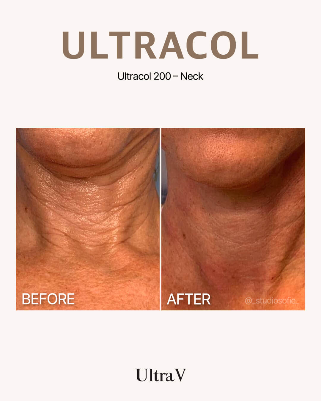 ウルトラコール症例写真3