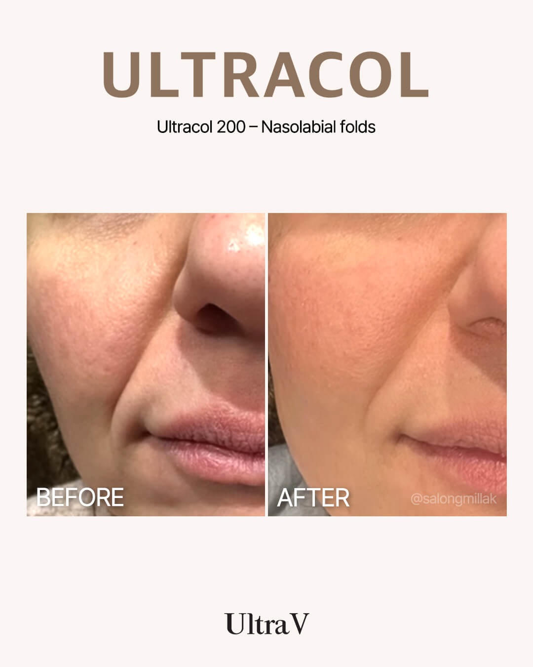 ウルトラコール症例写真4