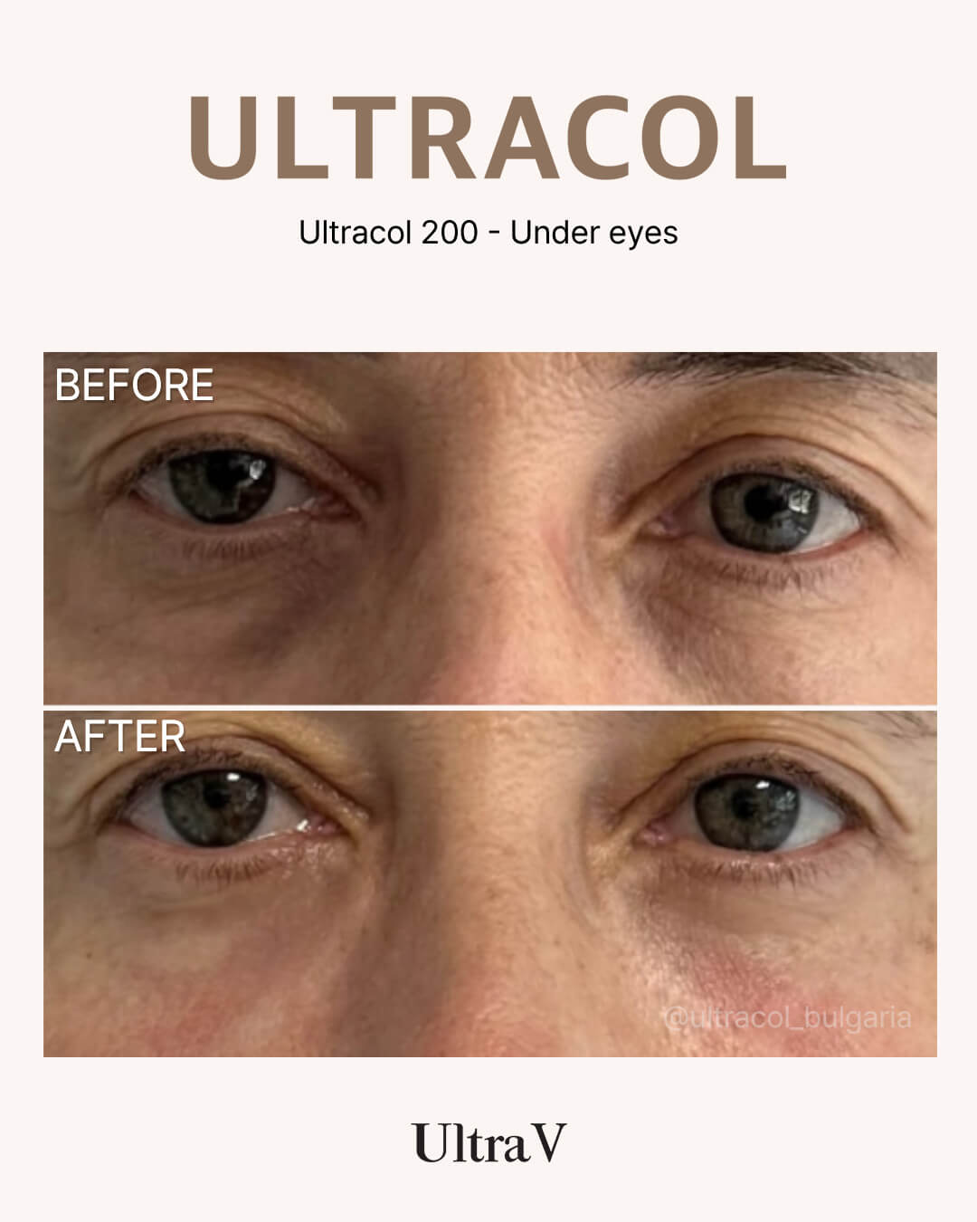 ウルトラコール症例写真5