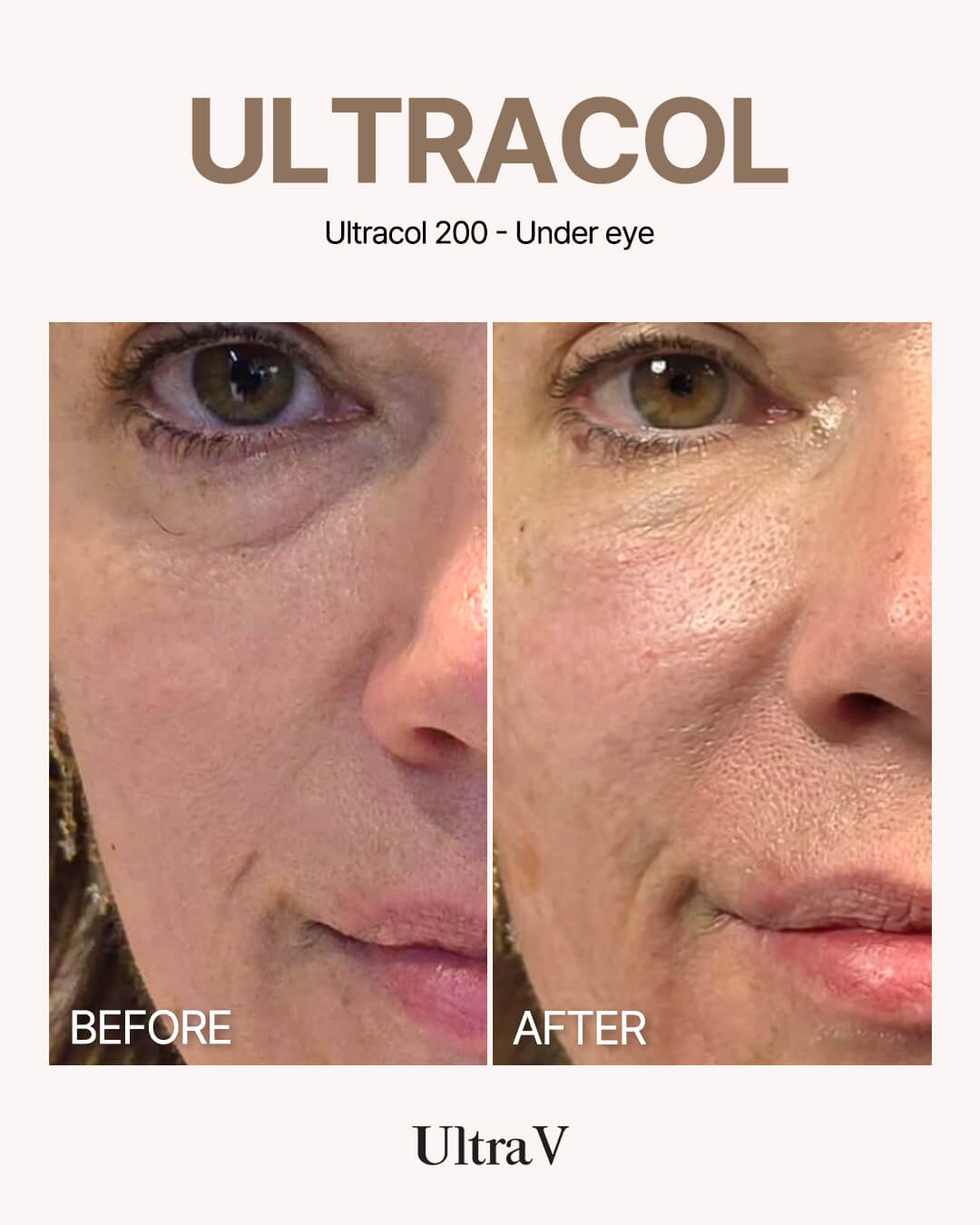 ウルトラコール症例写真6