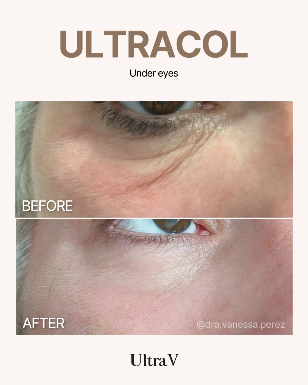 ウルトラコール症例写真7