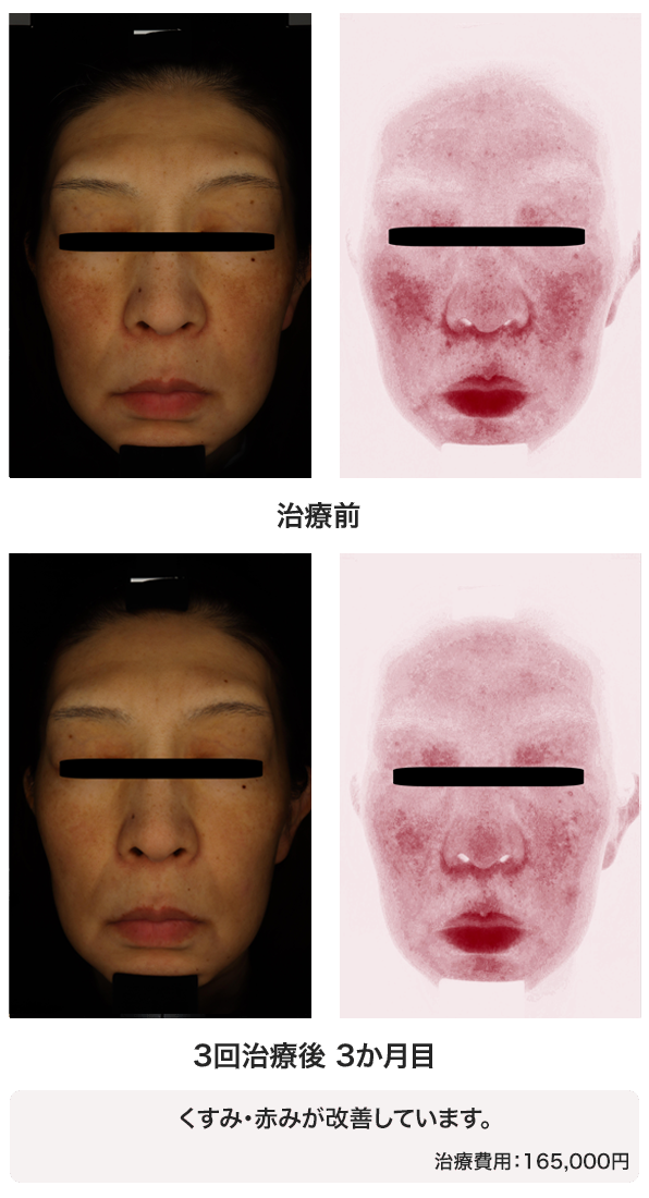 レッドタッチ・プロ｜症例4｜ビフォーアフター