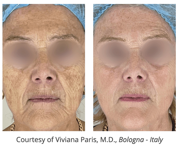 レッドタッチ・プロ|症例2|ビフォーアフター